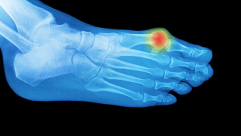 هجوم النقرس ألم إصبع القدم بالأشعة السينية